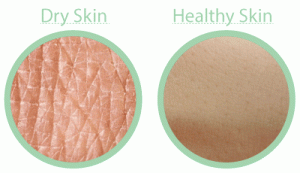 Dry Skin 1