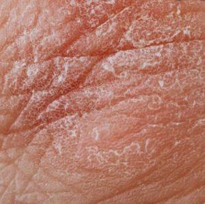 Signs you are dehydrated - Bad skin
